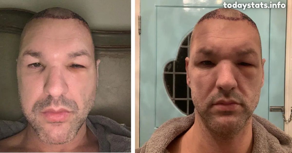 The Dangers of Turkey Hair Transplants: What You Need to Know?