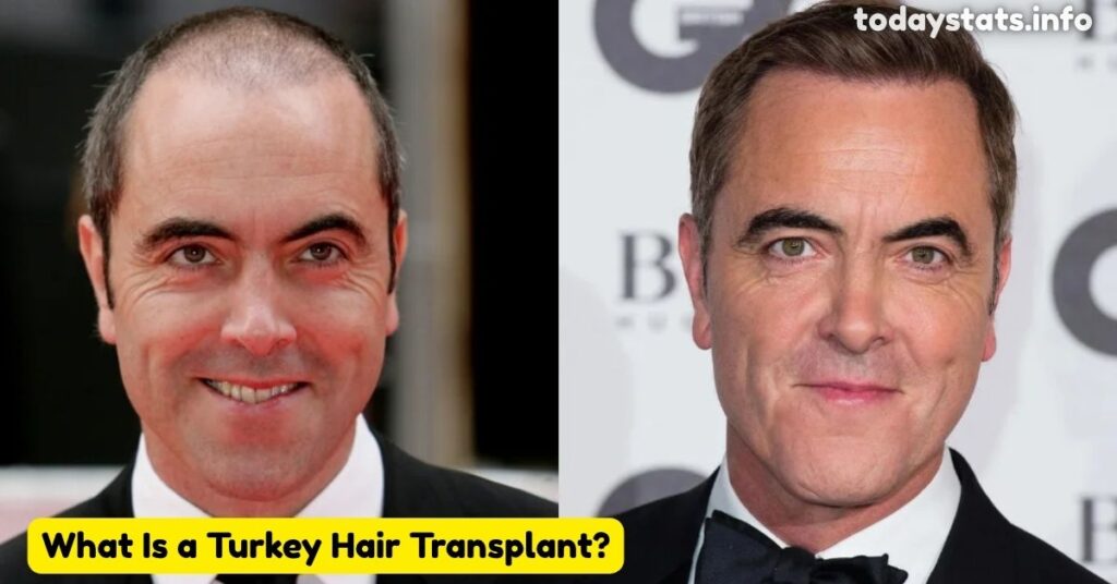The Dangers of Turkey Hair Transplants: What You Need to Know?