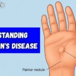 Understanding Dupuytren's Disease: Causes, Symptoms, and Treatment Options
